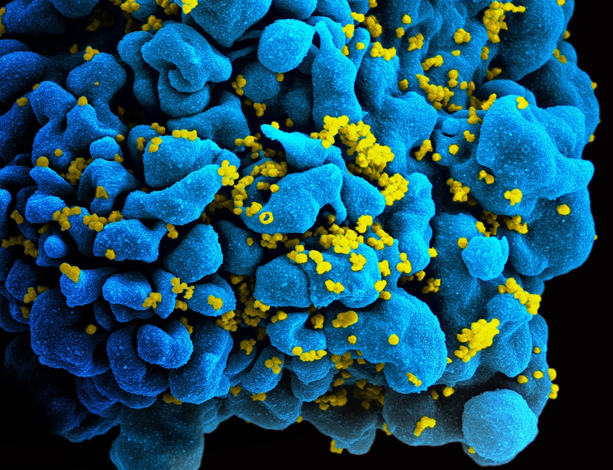 Т клеточный иммунодефицит. Вирус иммунодефицита под микроскопом. Вирус СПИДА фото. Т клеточные иммунодефициты.